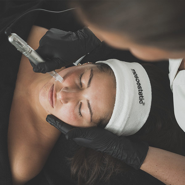 Microneedling Huidverbetering - Esprit De Vie